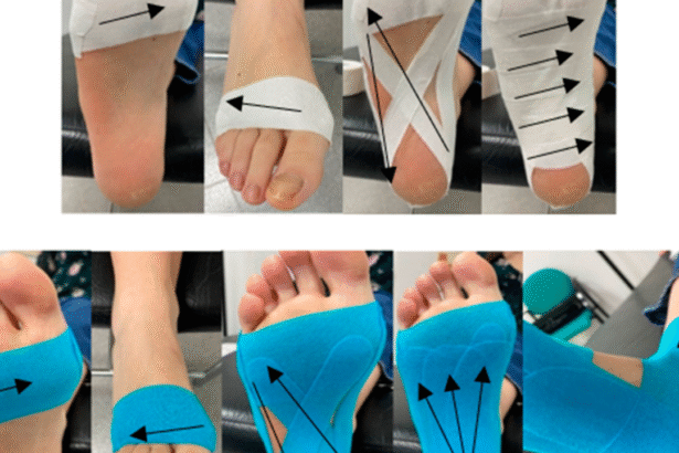 kt tape for shin splints